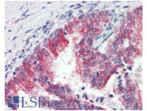 Human Prostate (formalin-fixed, paraffin-embedded) stained with ROR1 antibody ABIN462403 followed by biotinylated secondary antibody, alkaline phosphatase-streptavidin and chromogen.