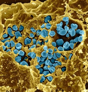 Macrophage infected with Francisella tularensis bacteria