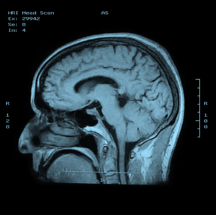 post-mortem neuropathologic tissue analysis